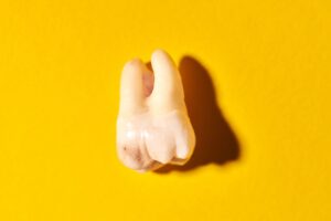 Wisdom tooth with tooth decay, yellow background